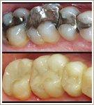 Tooth Colored Fillings