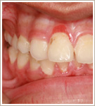 Gum Disease