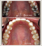 Inlay and Onlay Restorations