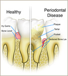 Periodontal Surgery