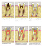 Root Canal Therapy