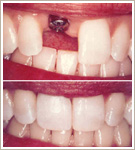 Tooth Replacement