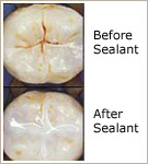 Tooth Sealant