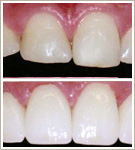 Lumineer Veneers