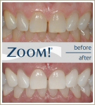 Take-home Whitening