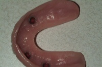 Implant Supported Denture